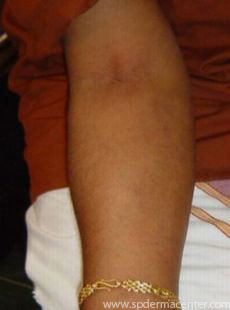 PIH-After